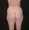 Liposuction to Hips