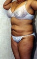 liposuction of abdomen and flanks