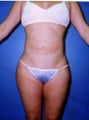 liposuction of abdomen and flanks of woman from Los Angeles