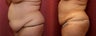 liposuction of abdomen and flanks of woman from Los Angeles