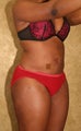 liposuction of abdomen and flanks of woman from Los Angeles
