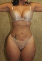 liposuction