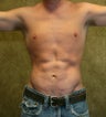 liposuction of abdomen and flanks of man from Los Angeles