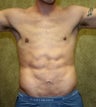 liposuction of abdomen and flanks of man from Los Angeles