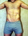 liposuction of abdomen and flanks of man from Los Angeles