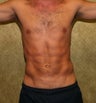 liposuction of abdomen and flanks of man from Los Angeles