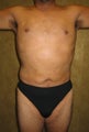 liposuction of abdomen and flanks of man from Los Angeles