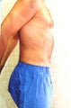 liposuction of abdomen and flanks of man from Los Angeles