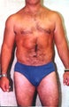 liposuction of abdomen and flanks of man from Los Angeles