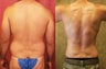 male liposuction of abdomen and flanks in los angeles