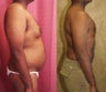 male liposuction of abdomen and flanks in los angeles