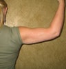 liposuction of arms for women