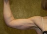 liposuction of arms for women