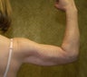 liposuction of arms for women