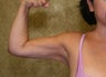 liposuction of arms for women