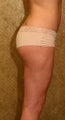 liposuction of thighs for women