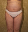 liposuction of thighs for women
