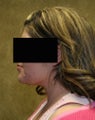 liposuction of neck & jaw line for women
