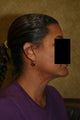 liposuction of neck & jaw line for women in Los Angeles