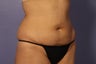 Liposuction