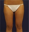 Liposuction