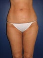 Liposuction of abdomen, hips, knees, and inner and outer thighs