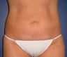 Liposuction of abdomen