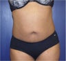 Liposuction abdomen and back