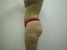 Lipo