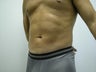 Lipo