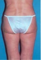 Liposuction
