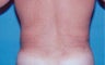 Liposuction For Men