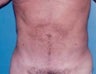 Liposuction For Men