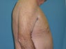 Liposuction For Men