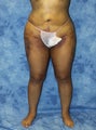 Liposuction and Fat Injection