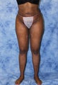 Liposuction and Fat Injection