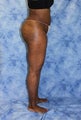 Liposuction and Fat Injection