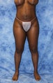 Liposuction and Fat Injection