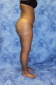 Liposuction and Fat Injection