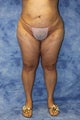 Liposuction and Fat Injection