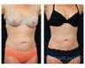 Liposuction