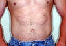 Liposuction