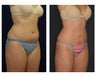 Liposuction