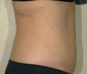 Liposuction and Tummy Tuck