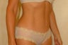 Liposuction and Tummy Tuck