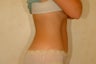 Tummy Tuck and Liposuction