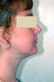 Neck Liposuction