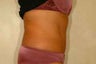 Lipo-abdominoplasty