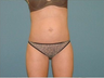 Liposuction