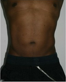 Liposuction